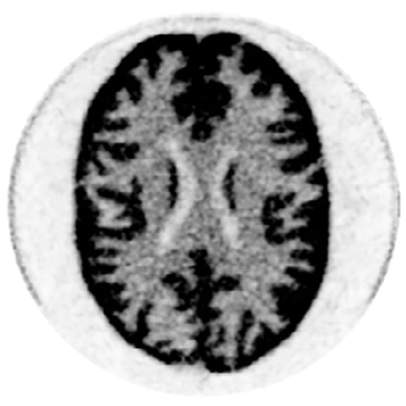 3D Hoffman brain phantom, ICS events only, reconstructed with D3Recovery